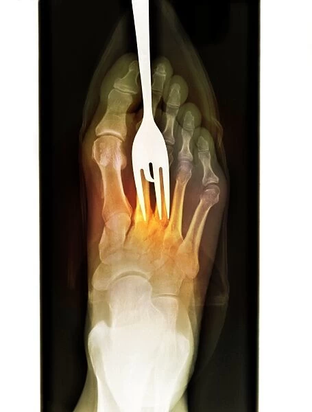 Foot fork-stabbing injury, X-ray