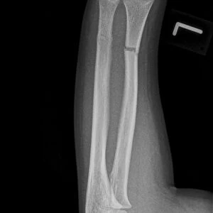 Broken arm, X-ray C017 / 7264