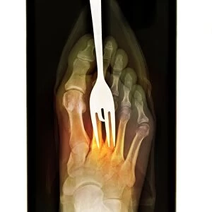 Foot fork-stabbing injury, X-ray